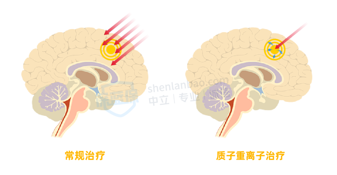 「治癌利器」质子重离子，真的要花上千万？保险能报吗？
